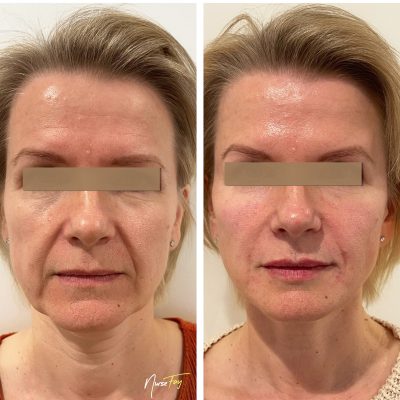 Before and After Image of Liquid Facelift Treatment | Spa Medica Aesthetic in Los Angeles, CA