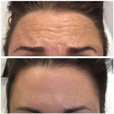 Before and After Image of Botox Treatment | Spa Medica Aesthetic in Los Angeles, CA