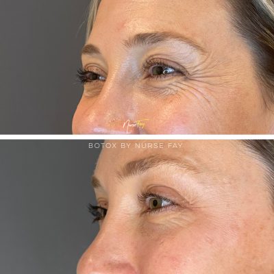 Before and After Image of Botox Treatment | Spa Medica Aesthetic in Los Angeles, CA