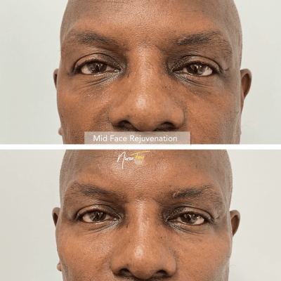 Before and After Image Of Male Mid Face Rejuvenation | Spa Medica Aesthetic in Los Angeles, CA