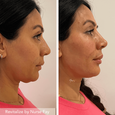Before and After Image of Liquid Facelift Treatment | Spa Medica Aesthetic in Los Angeles, CA
