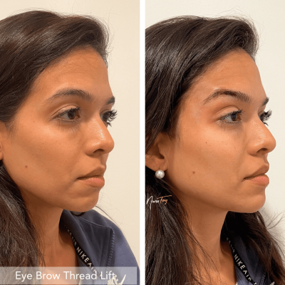 Before and After Image Of Eye Brow Thread Lift Treatment | Spa Medica Aesthetic in Los Angeles, CA