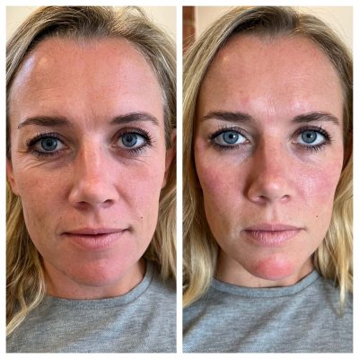 Before and After Image Of Under-eyes Filler | Spa Medica Aesthetic in Los Angeles, CA
