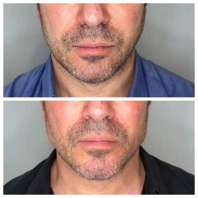 Before and After Image Of Male Face Rejuvenation Treatment | Spa Medica Aesthetic in Los Angeles, CA