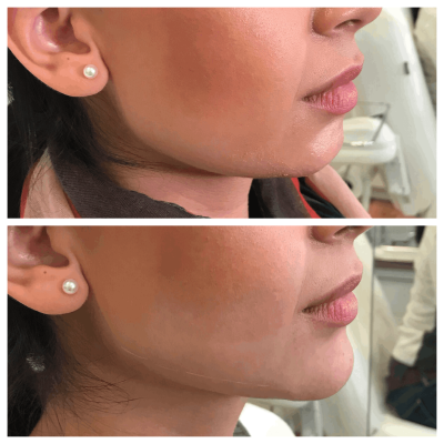 Before and After Image Of Kybella Double Chin Removal Treatment | Spa Medica Aesthetic in Los Angeles, CA