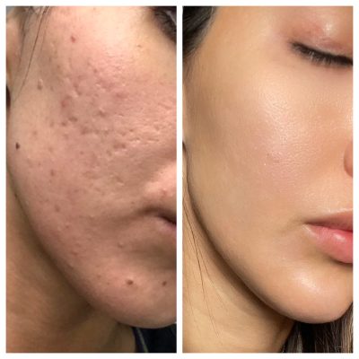 Before and After Image of Microneedling Treatment | Spa Medica Aesthetic in Los Angeles, CA