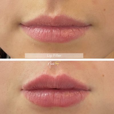 Before and After Image of Lip Filler Treatment | Spa Medica Aesthetic in Los Angeles, CA