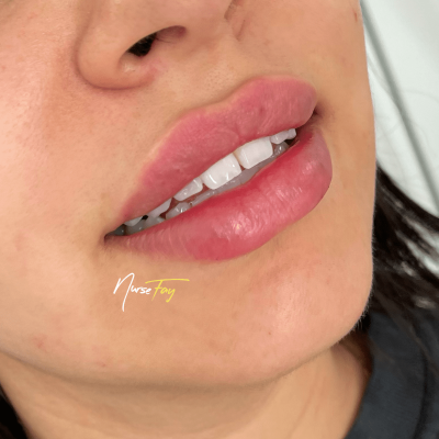 Lip Filler By Spa Medica Aesthetic in Los Angeles, CA