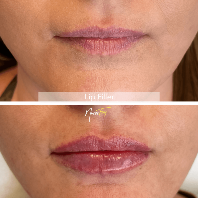 Before and After Image of Lip Filler Treatment | Spa Medica Aesthetic in Los Angeles, CA