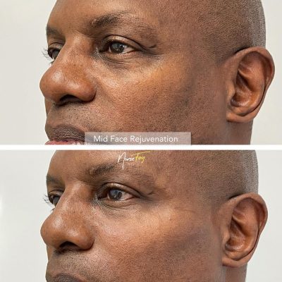 Before and After Image Of Male Mid Face Rejuvenation Treatment | Spa Medica Aesthetic in Los Angeles, CA