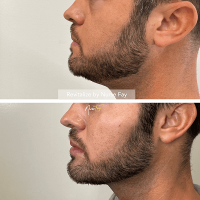 Before and After Image of Male Face Rejuvenation Treatment | Spa Medica Aesthetic in Los Angeles, CA