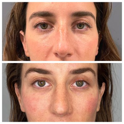 Before and After Image Of Under-eyes Filler | Spa Medica Aesthetic in Los Angeles, CA