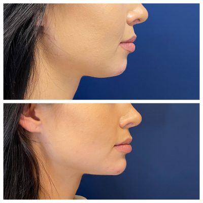 Before and After Image Of Kybella Double Chin Removal Treatment | Spa Medica Aesthetic in Los Angeles, CA