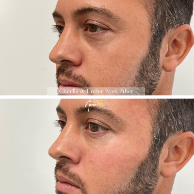 Before and After Image Of Cheeks & Under Eyes Filler Treatment | Spa Medica Aesthetic in Los Angeles, CA