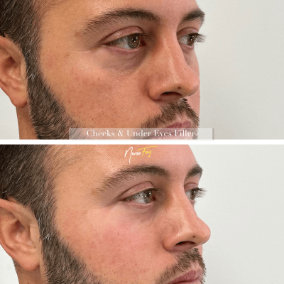 Before and After Image Of Cheeks & Under Eyes Filler Treatment | Spa Medica Aesthetic in Los Angeles, CA